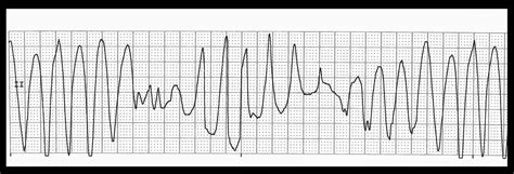 Float Nurse: Basic EKG Rhythm Test 16