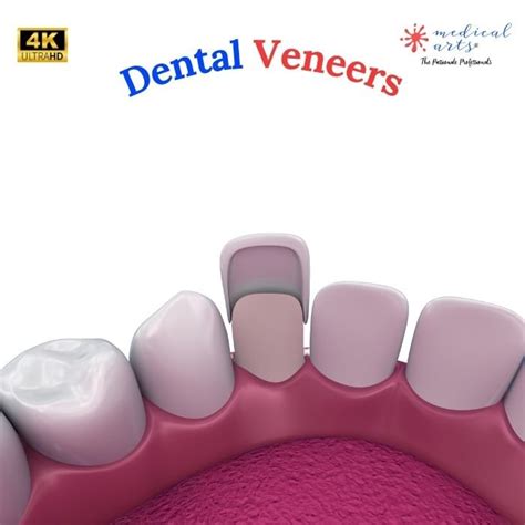 Dental Veneers Procedure - Video & Article – Medical Arts Shop