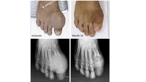 The Shrinking Toe: A Sign of Crystal Dissolution During Urate Lowering ...