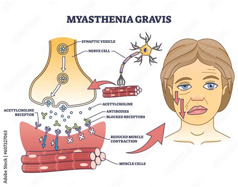 Myasthenia gravis as autoimmune, neuromuscular disease outline diagram. Labeled educational ...