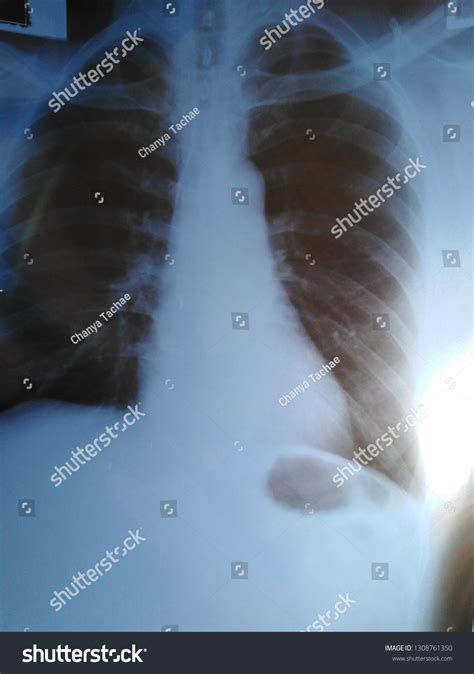 Human Chest Xray Images Medical Diagnosis Stock Photo 1308761350 | Shutterstock