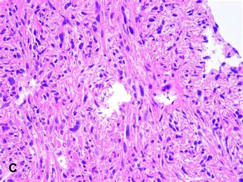 American Urological Association - Leiomyosarcoma