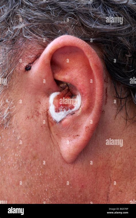 Bleeding ear hi-res stock photography and images - Alamy