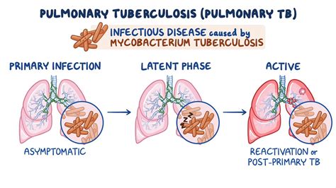 Tuberculosis (pulmonary): Clinical sciences - Osmosis Video Library