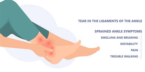 Ankle Sprain Physiotherapy - Propel Physiotherapy