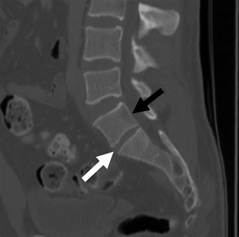 Lumbarisation