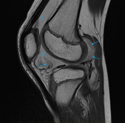 11-juvenile-chronic-arthritis-mri-knee - MRI at Melbourne Radiology Clinic