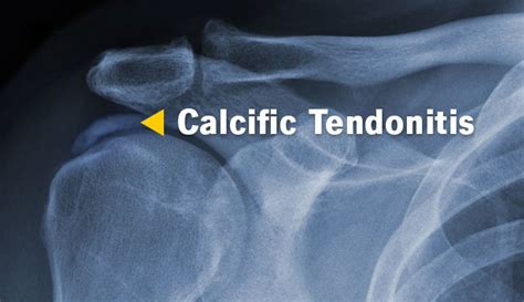 Calcific Tendonitis: Symptoms, Causes, & Treatment