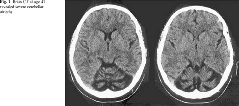 Brain CT at age 47 revealed severe cerebellar atrophy | Download Scientific Diagram