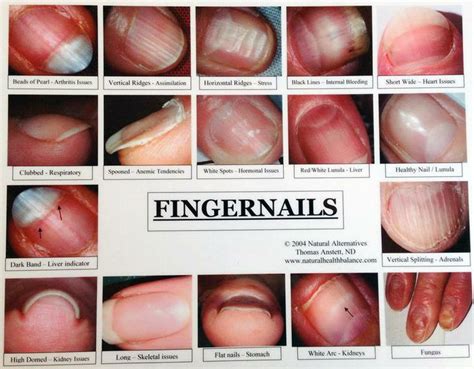 Pin by Ashley Layfield on Young essentials oils | Nail health signs, Health signs, Fingernail health