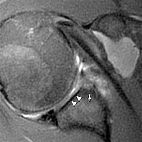 Imaging the Glenoid Labrum and Labral Tears | RadioGraphics