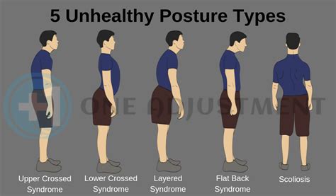 5 Posture Types You Can Change for Good - One Adjustment | Postures, Exercise, Standing posture