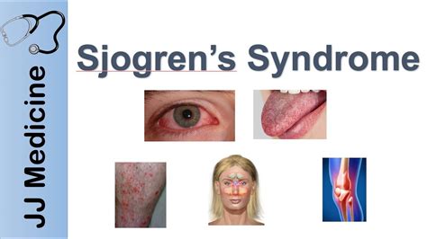 Sjogren's Syndrome: What Is, Types, Symptoms, Treatment, and Management