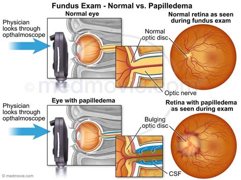 Papilledema (ReelDx) - SMARTY PANCE