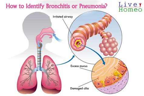 How to Identify Bronchitis or Pneumonia? – Live Homeo