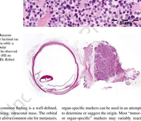 136 Olfactory neuroblastoma (esthesioneuroblastoma): direct extension... | Download Scientific ...