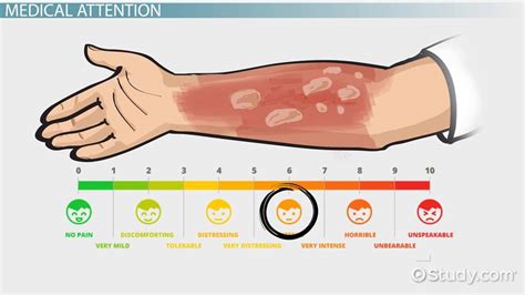 How to Treat a Burn from Boiling Water - Lesson | Study.com