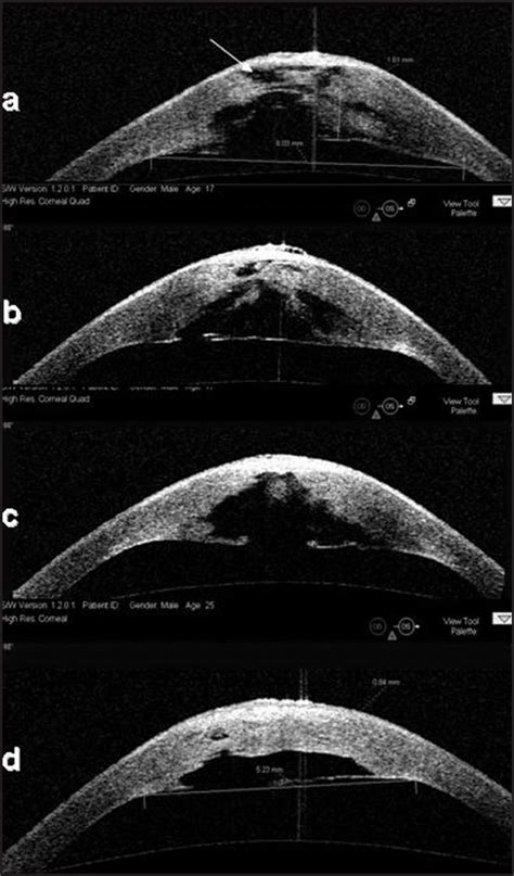 Optical coherence tomography – Artofit