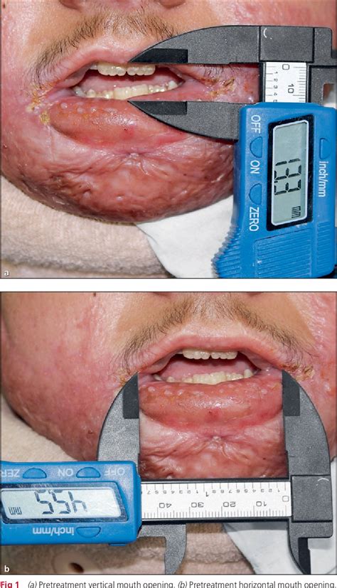 Figure 1 from Prosthetic Management of Microstomia with Customized Dynamic Splint. | Semantic ...