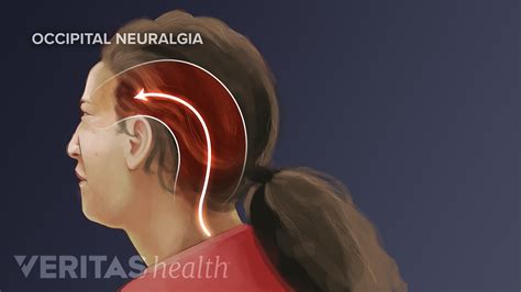 Occipital Neuralgia Treatment