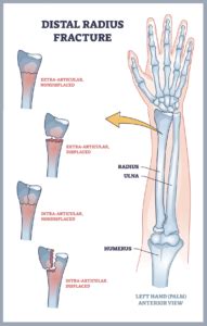 Wrist Sprain vs. Wrist Fracture | Advanced Ortho and Spine