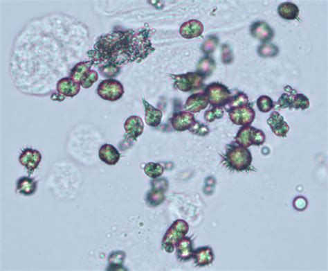 Ammonium biurate crystals | eClinpath