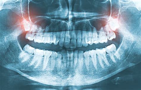 Sinusitis and Toothache 101: How are they related to each other?