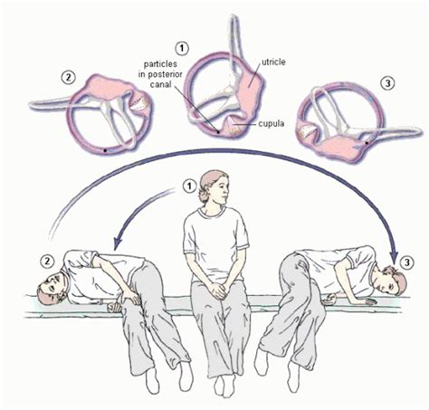 22+ Epley Maneuver Patient Instructions Gif