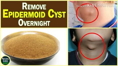 AMAZING!!!Home Remedy To Remove Cysts And Grease Bail Forever In Just 7 Days - YouTube