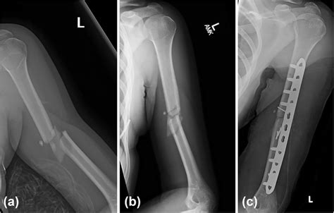 X-rays of a 23-year-old female who sustained a midshaft fracture of her ...