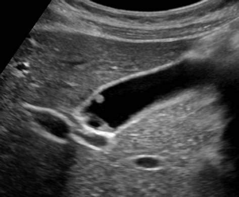 Abdomen and retroperitoneum | 1.2 Gallbladder and bile ducts : Case 1.2 ...