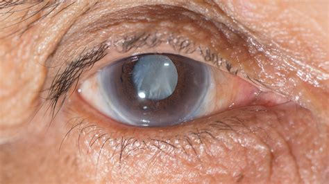 CATARACT EVALUATION AND SURGERY - PghEyeMeds