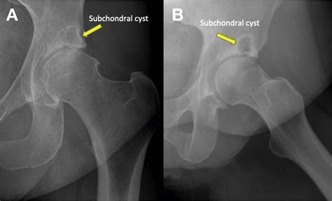 Surgical Treatment of Subchondral Bone Cysts of the Acetabulum With Calcium Phosphate Bone ...