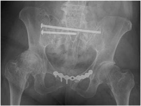 Postoperative anteroposterior pelvic radiograph after stabilization of... | Download Scientific ...