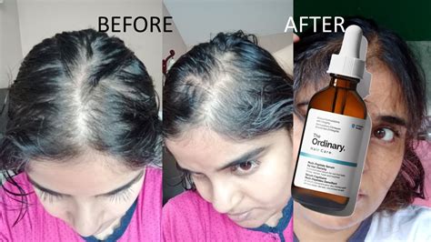 The Ordinary Hair Serum Review : Before & After - Multi-Peptide Serum ...