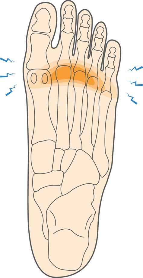 What is Metatarsalgia & How to Relieve Ball of Foot Pain? - Upswing Health