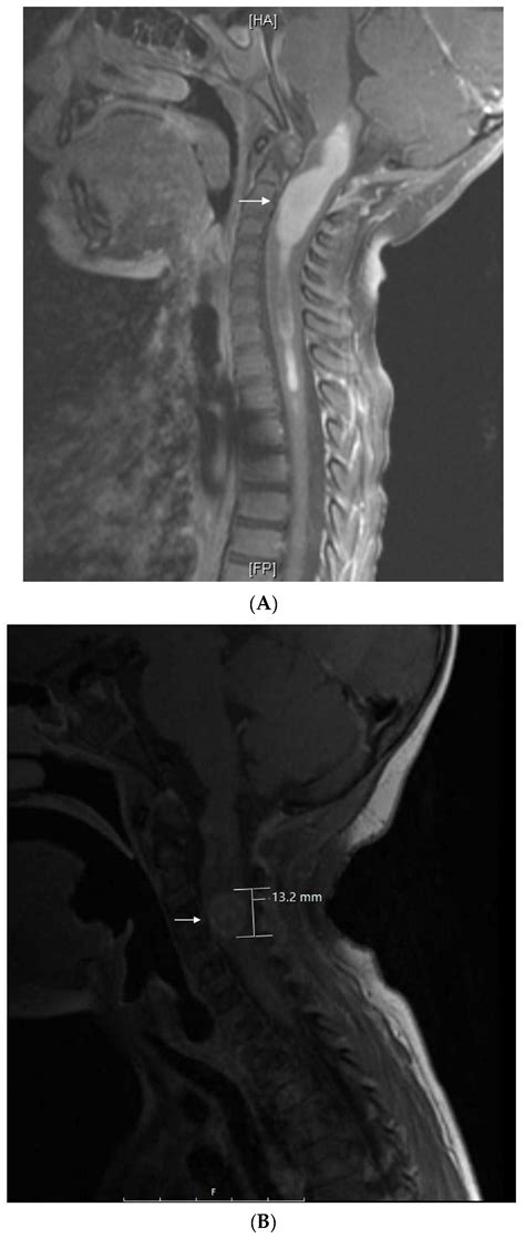 JCM | Free Full-Text | Cyclic Metronomic Chemotherapy for Pediatric Tumors: Six Case Reports and ...