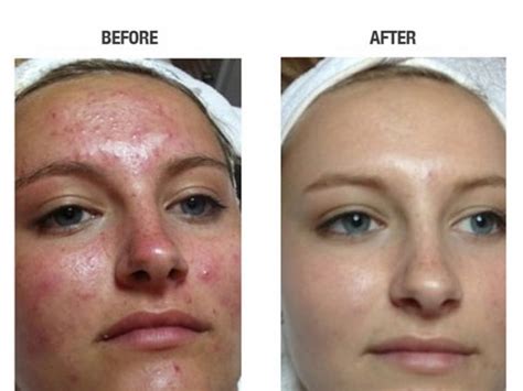 The pros and cons of Acne Laser Treatments - Medi Port Services - latest advice on staying healthy