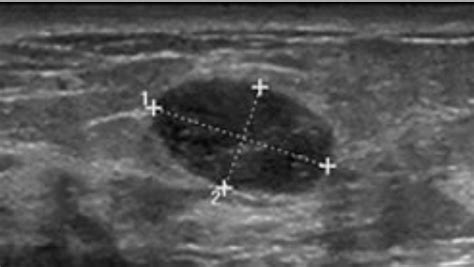 How I Dissolved My Fibroadenoma Without Surgery