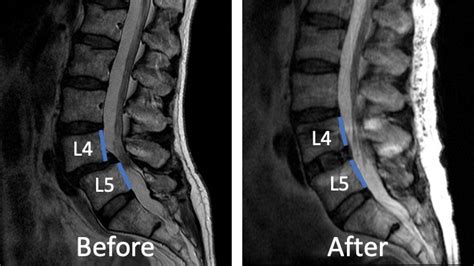 OLIF — Matthew Mian, MD