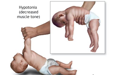 Hypotonia in Babies - Signs, Causes, Diagnosis and Treatment - Being ...