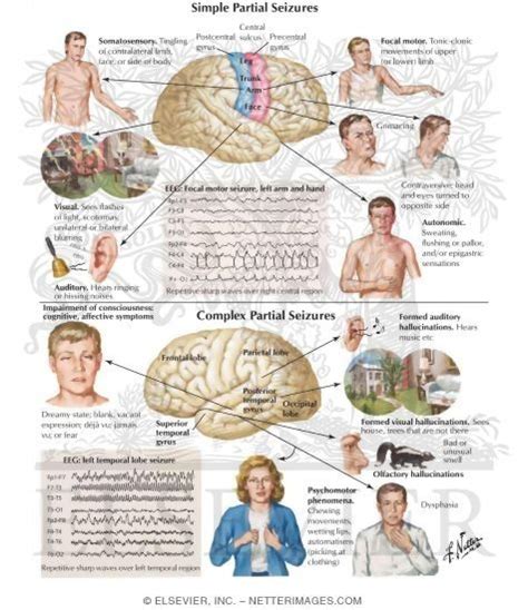 Epilepsies, Partial; Epilepsy, Focal; Epilepsy, Simple Partial; Seizure Disorder, Partial ...