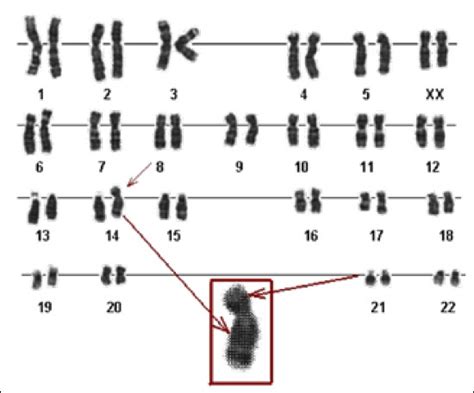 Translocation Down Syndrome Karyotype