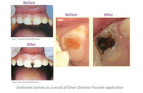 Silver Diamine Fluoride (SDF) Treatment – Kaunakakai HI | Nalu Dental