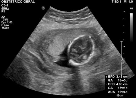 【ベストコレクション】 24 weeks pregnant ultrasound gender 220010-24 weeks pregnant ultrasound boy