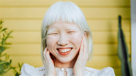 Albinism: Causes, Types, Pictures, Symptoms, and More