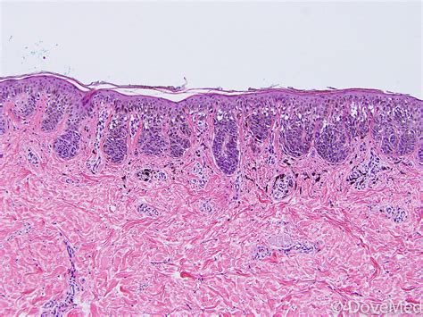 Superficial Spreading Melanoma of Skin