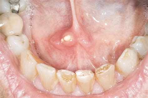 Salivary gland stones - NHS