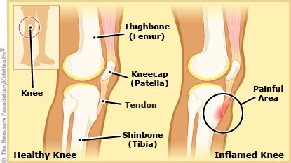 Osgood-Schlatter Disease | Dayton Children's Hospital