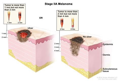 Melanoma Treatment (PDQ®)—Patient Version - National Cancer Institute